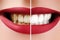 Closeup Macro of Female Teeth Before and After Whitening. Dental Health and Oral Care Concept. Happy Smile with Red Lips