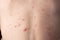 Closeup a man back who having varicella blister or chickenpox