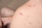 Closeup a man back who having varicella blister or chickenpox