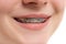 Closeup multicolored Braces on Teeth. Beautiful Female Smile wit