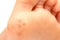 Closeup of plantar warts under foot of a child