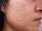 Closeup scar acne