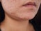 Closeup scar acne