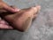 Closeup Shot Of Cracked  Ankles Photos Background Blue