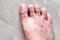 Closeup skin athleteâ€™s foot psoriasis fungus, hong kong foot,