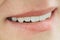 Closeup smile photo with zirconium artificial teeth. Zirconia bridge with porcelain.