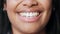 Closeup of smiling ptient showing perfect white teeth with orthodontic invisible braces, teeth whitening treatment or