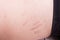 Closeup on stretch marks or cellulite on waist belly