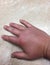 Closeup of swollen hand with bug bite and red skin
