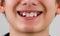 closeup teenager boy mouth with diastema overbite teeth missing gap wearing orthodontic appliance treatment.