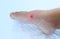 closeup of weeping wound, trophic ulcer on female leg, wound exudate prevents healing ulcers by destroying growth factors, concept