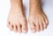 Closeup woman cracked feet and heels on white background, health