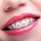Closeup of woman open smiling mouth with brackets