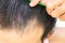 Closeup young man serious hair loss problem