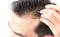 Closeup young man serious hair loss problem for health care sham