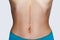 Closeup of young woman with large scar after surgery on abdomen