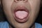 Coated tongue or white tongue. Loss of taste called ageusia