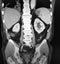 Coccidioides imitis Right Lower Lung Cavitary Pneumonia