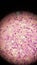 Coccidioides imitis spherules in skin biopsy specimen