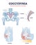 Coccydynia as pain felt in coccyx or tailbone anatomical outline diagram