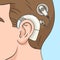 Cochlear implant diagram medical science