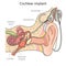 Cochlear implant diagram medical science