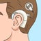 Cochlear implant diagram medical science