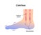 Cold foot blood circulation illustration sensitivity to cold, cold toes