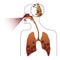 Colds and inflammation. Flu. Silhouette of human lungs with coronavirus. Pneumonia illustration