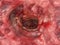 Colitis ulcerosa - Stage 4 - 3D rendering