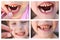 A collage of the child has lost the baby tooth. At 6 years old child loose tooth. The girl is holding the tooth in his hand.