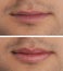 Collage with photos of man before and after lips augmentation, closeup