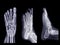 Collection of Foot x-ray image  isolated on black background