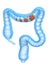 Colon cancer stages