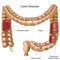 Colon pathologies