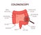 Colonoscopy concept. Intestine exam and treatment. Bowel polypectomy procedure. Anatomy of colon. Prevention of cancer