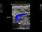 Color Doppler ultrasound determination in deep vein thrombosis patients for finding  deep vein thrombosis of lower extremity