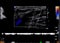 Color Doppler ultrasound determination in deep vein thrombosis patients for finding  deep vein thrombosis of lower extremity