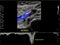 Color Doppler ultrasound determination in deep vein thrombosis patients for finding  deep vein thrombosis of lower extremity