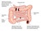 Colostomy sites