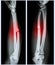 Comminuted fracture shaft of ulnar bone