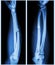 Comminuted fracture shaft of ulnar bone