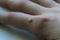 Common wart  Verruca vulgaris  a flat wart commonly found on the hand  of children and  adults. They are caused by a type of