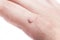 Common wart Verruca vulgaris a flat wart commonly found on the hand of children and adults. They are caused by a type of human