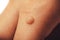 Common wart Verruca vulgaris a flat wart commonly found on the hand of children and adults. They are caused by a type of human