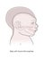 Comparative anatomical image of the head and skull of a newborn child with a normal cranium and with microcephaly and severe