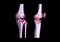 Compare AP and lateral view of CT knee joint 3D rendering image  showing fracture tibia bone