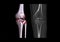 Compare of CT knee joint 3D rendering image  and CT knee 2D Coronal view isolated on black background showing fracture tibia bone