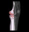 Compare of CT knee joint 3D rendering image and CT knee 2D isolated on black background showing fracture tibia bone
