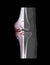 Compare of CT knee joint 3D rendering image and CT knee 2D isolated on black background showing fracture tibia bone